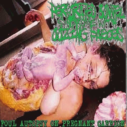 Perforated Bowel Syndrome With Oozing Faeces : Foul Autopsy on Pregnant Carrion